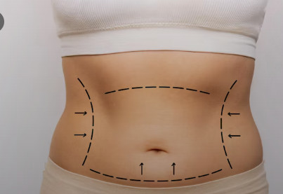 عملية شد البطن